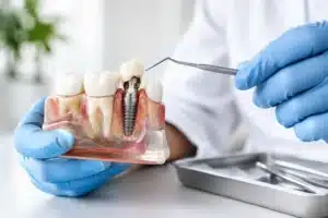 Qué causa el fracaso de un implante dental